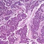 Классификация рака поджелудочной железы